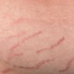 Stretch Marks: What Can You Do?